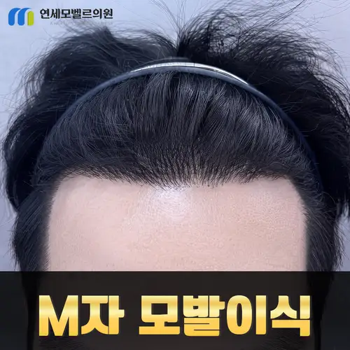 인천 연세모벨르의원 · 자신감 있는 이마 라인 안내 이미지